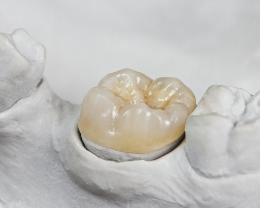 dental crowns oldbury