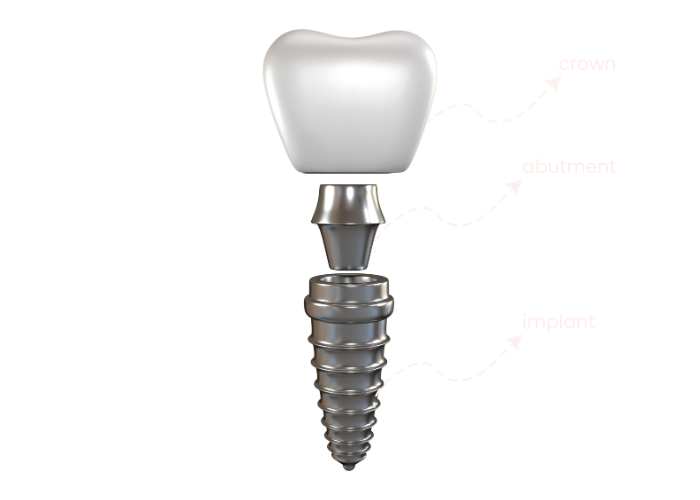 how a dental implant looks like