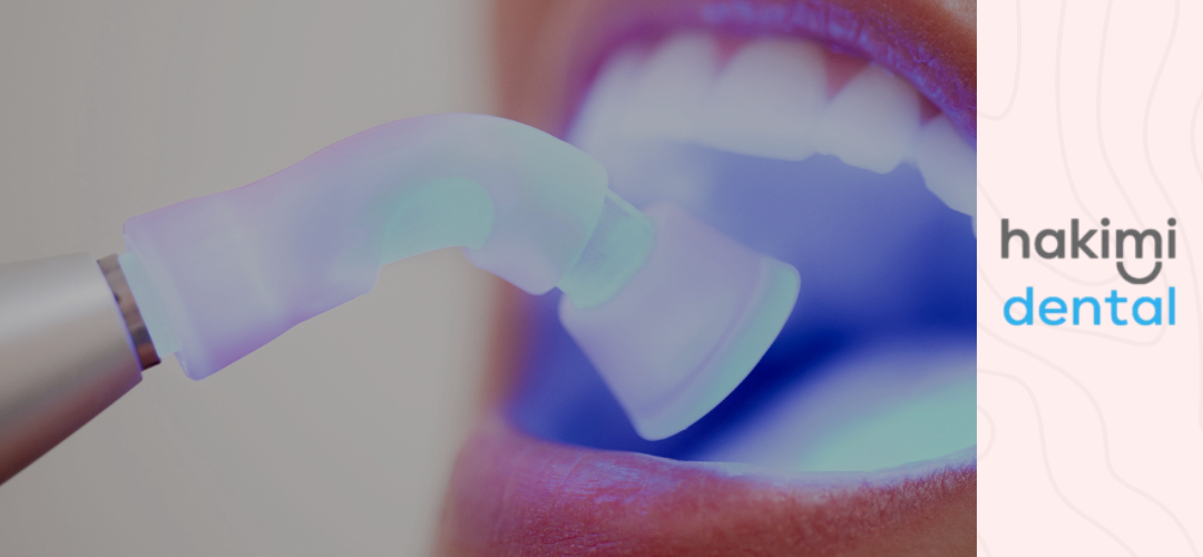 Eating After a Cavity Filling – What to Know