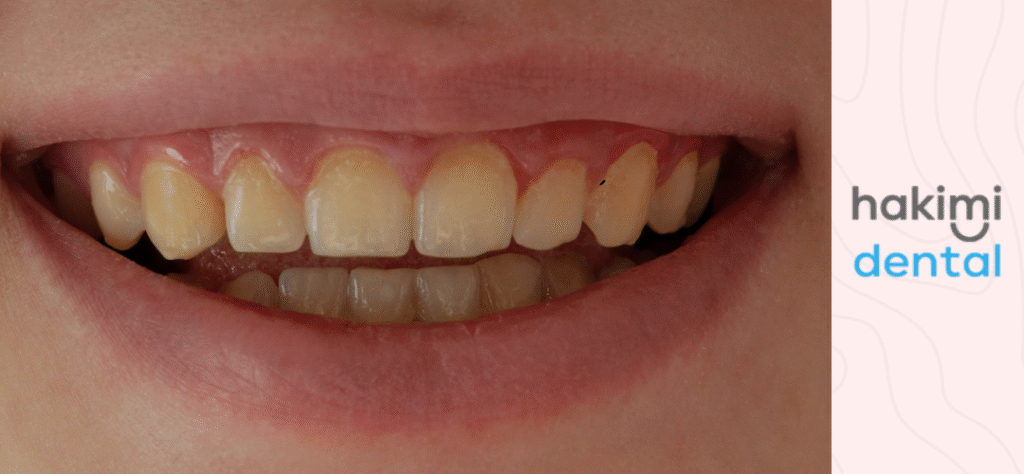 black spot on tooth - smile with black spot