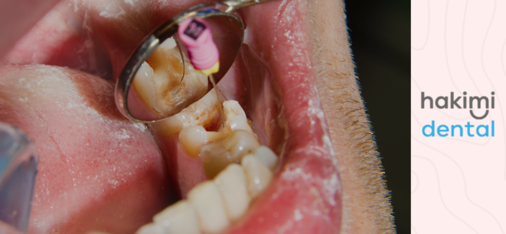 how long will a root canal take - photo during root canal treatment procedure