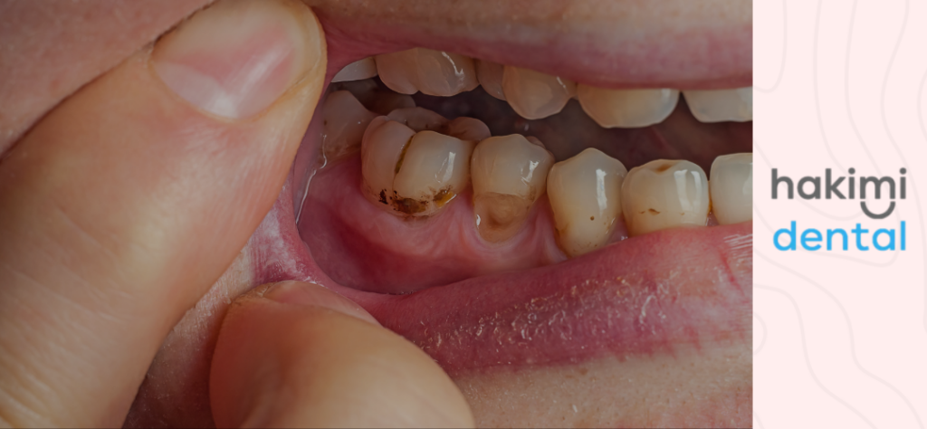can dentists tell if you smoke - blog cover photo