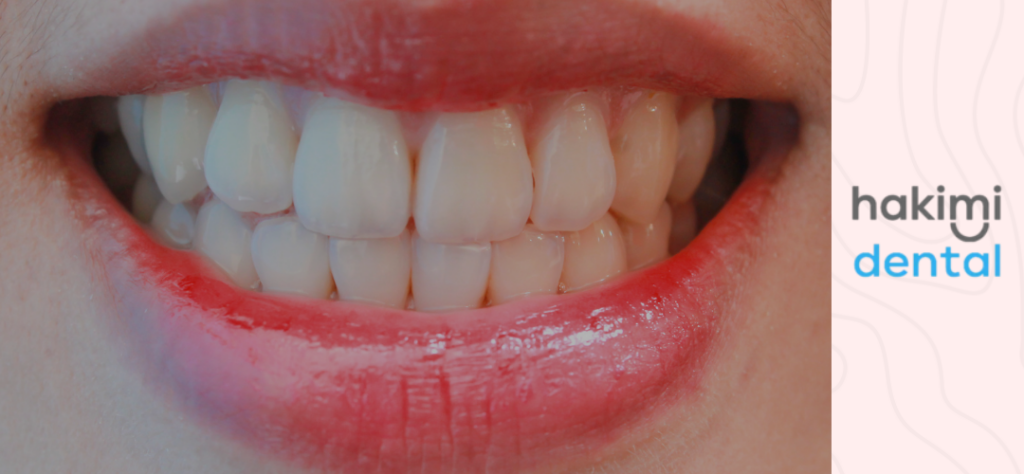 sensitive front teeth - front tooth pain