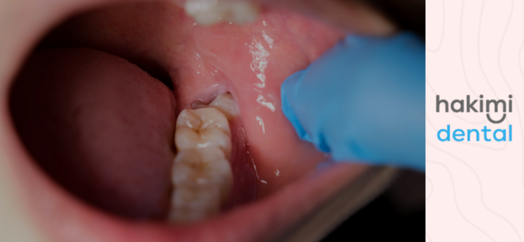 how to help wisdom tooth pain - photo with partially erupted wisdom tooth