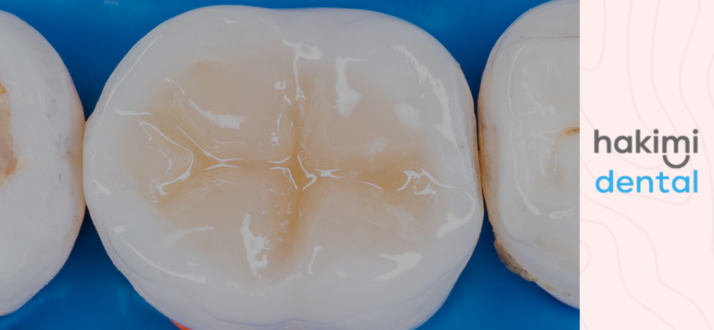 tooth filling - photo with a restored tooth