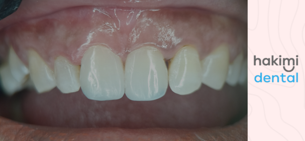 black gums - what it means